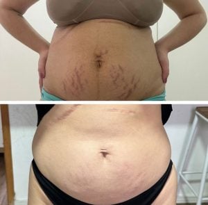 Kit antestrias cicatribem — foto 4