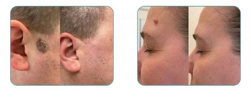 Remoção a laser de pintas e verrugas — foto 2