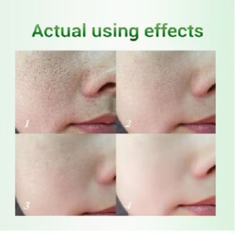 20ml De Creme De Ácido Salicílico Para Remoção De Poros/Acne E Iluminador/Limpeza/Controle — foto 2