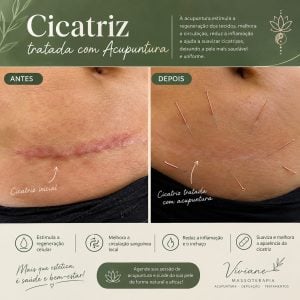 Acuputura e cicatrizes — foto 4