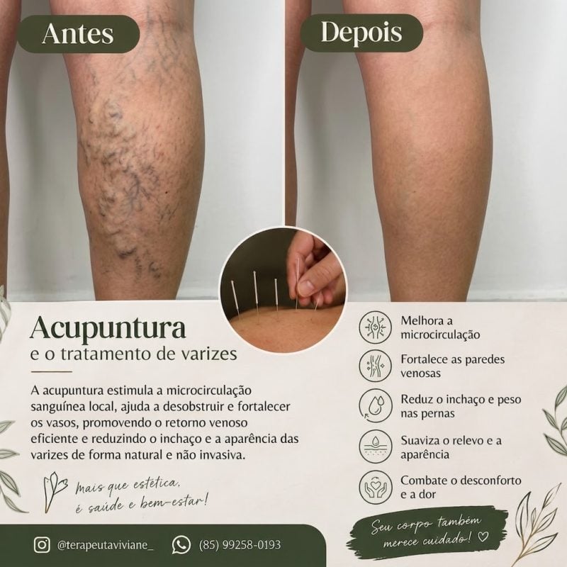 Tratamento para varizes