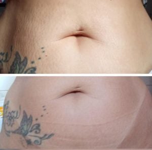 Kit antestrias cicatribem — foto 5