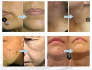 Remoção a laser de pintas e verrugas — foto 3