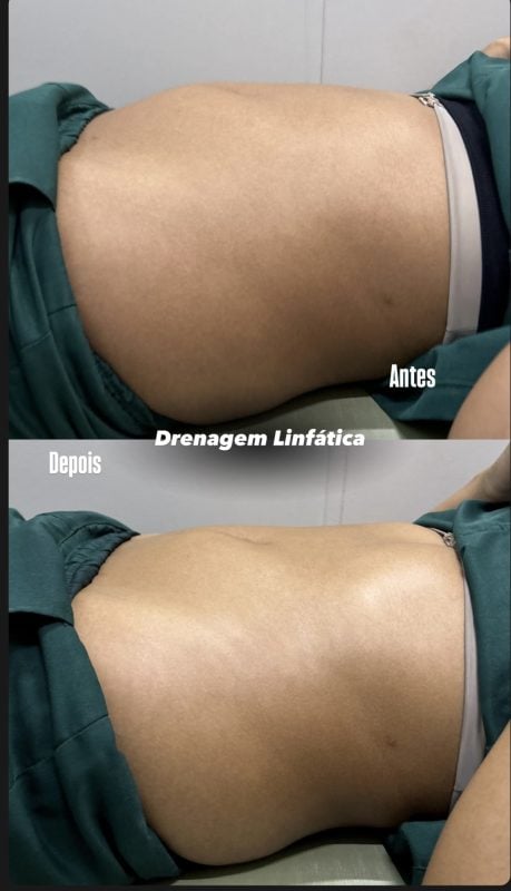Massagem e Drenagem Linfática