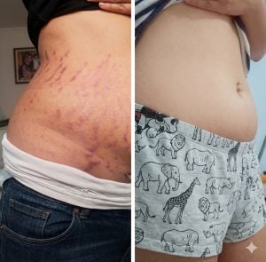 Kit antestrias cicatribem — foto 3