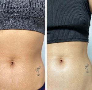 Kit antestrias cicatribem — foto 6
