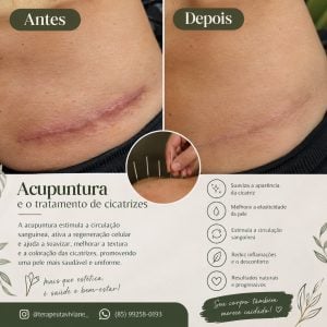Acuputura e cicatrizes — foto 3