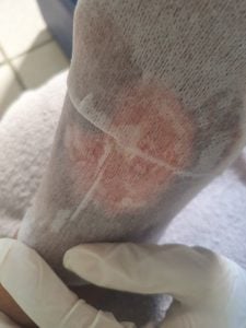 Curativos Domiciliares E Laserterapia Nova Iguaçu E Região — foto 5